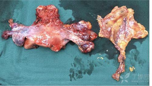 割子宫手术视频,医学奇迹与伦理争议并存