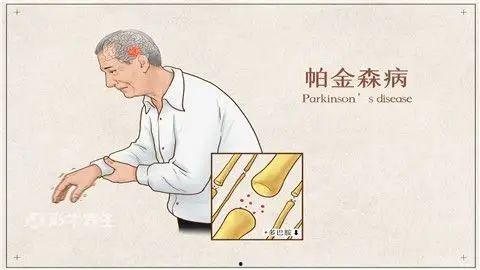 帕金森症状视频,视频揭示的典型表现与挑战