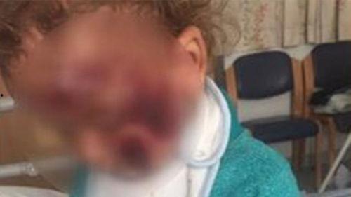 小孩被热水烫伤的视频,孩子不幸烫伤，温馨提醒家长防范意外